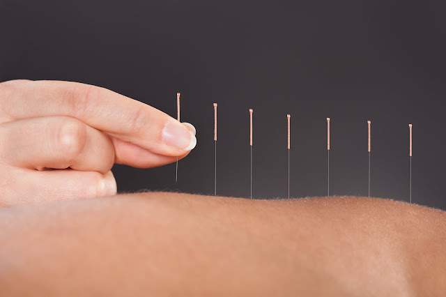 Acupuncture Treatments acupuncture treatments