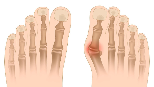 Get Relief from Bunions: Non-Surgical Treatment for Bunions bunions