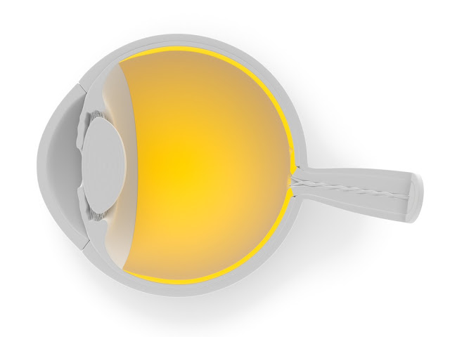 Ocular Albinism occular albinism