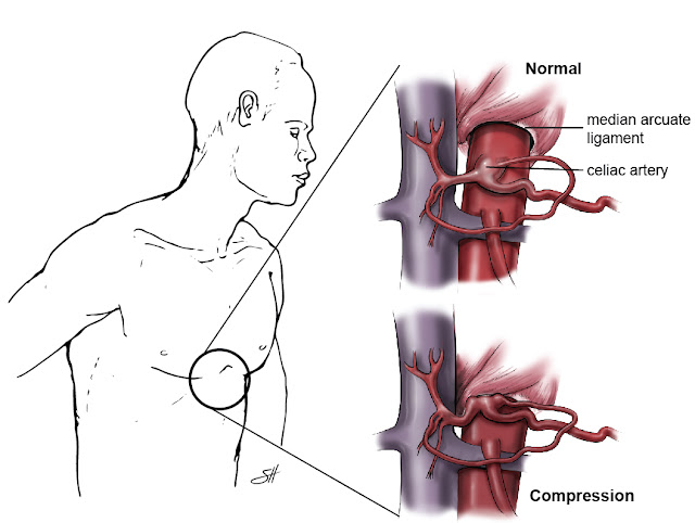 Celiac Artery Compression Syndrome – Symptoms celiac artery compression syndrome