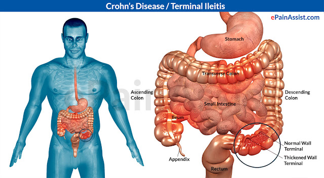 Crohn’s Disease: Symptoms, Causes and Treatment crohns disease