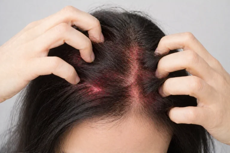 Person scratching itchy scalp showing symptoms of dry scalp and dandruff