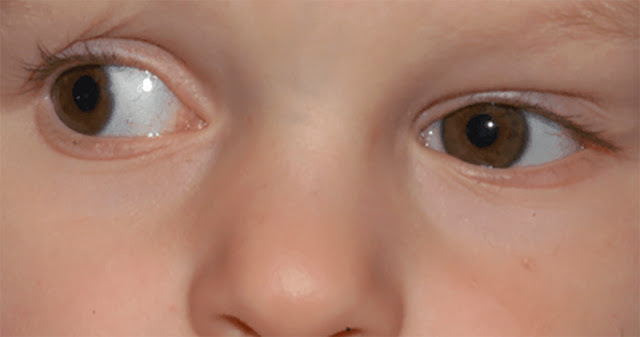 What is Duane Syndrome duane syndrome