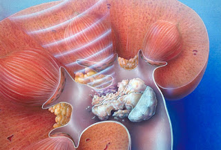 Kidney Stones kidney stones