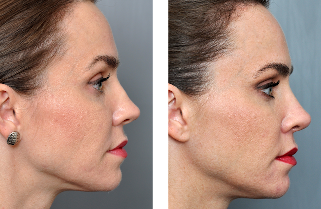 What is Involved in Rhinoplasty rhinoplasty