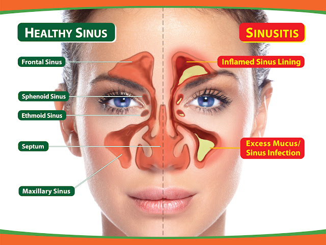 How to Treat the Symptoms of a Sinus Infection sinus infection