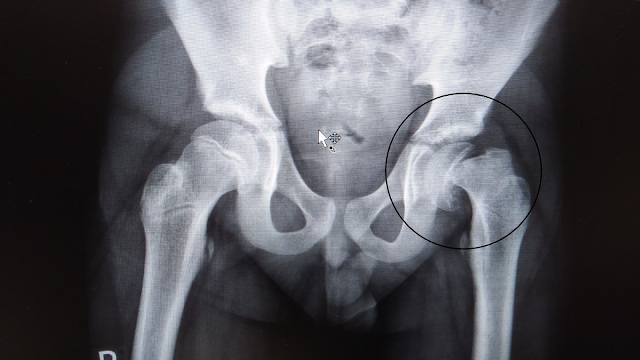 Slipped Femoral Epiphysis slipped femoral epiphysis