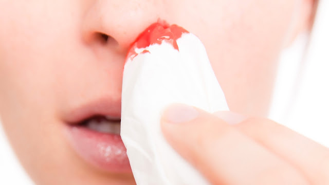 How to Stop a Nosebleed stop nosebleed