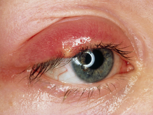 Stye – Symptoms and Treatment stye